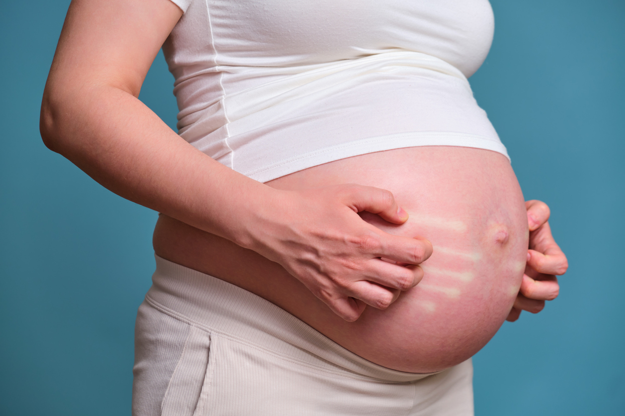 Itchy Hands And Feet During Pregnancy Not Cholestasis